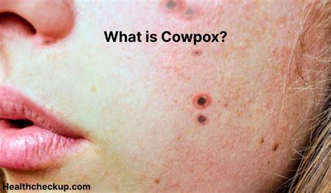 Cowpox - Symptoms, Diagnosis, Treatment, Prevention - Health CheckUp