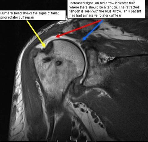 Boston Shoulder Institute – MRI rotator cuff tear