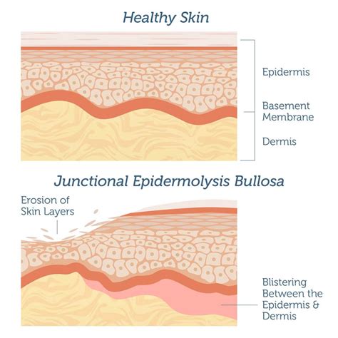 Junctional Epidermolysis Bullosa - Genebase