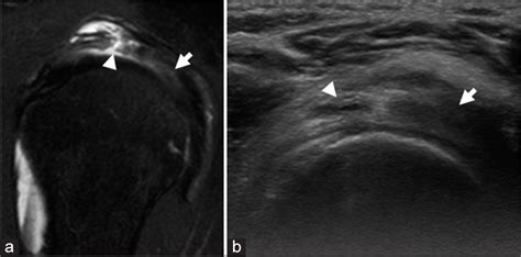 Rotator Cuff Ultrasound Images