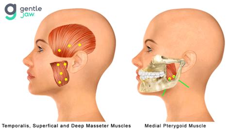 Botox for TMJ Myofacial Muscle Pain