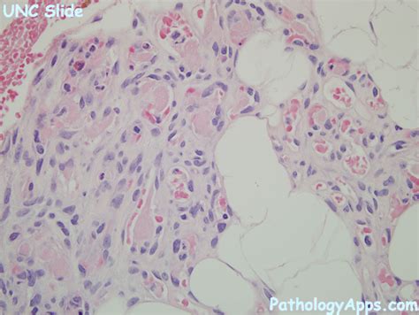 angiolipoma pathology