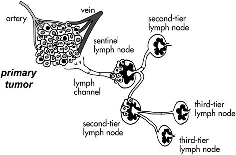 Draining Lymph Node Definition - Best Drain Photos Primagem.Org