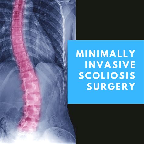 Minimally-Invasive Scoliosis Surgery | New Jersey | Comprehensive Spine Care