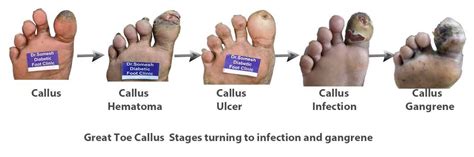 Diabetic Foot Gangrene stages Great Toe Tip - Podiatry Doctor