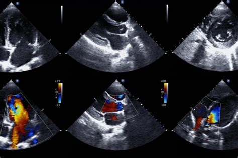 What to Expect during an Echocardiogram | UPMC HealthBeat