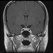 Pituitary Mri