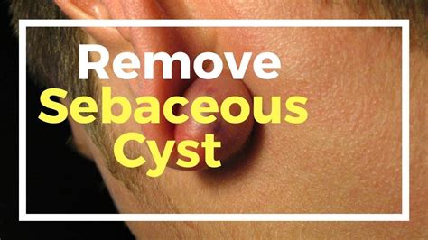 18 Remedies to Remove Sebaceous Cyst Naturally at Home | Cysts, Remedies, Nature