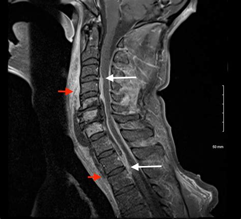 Spinal Epidural Abscess