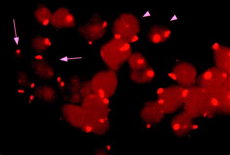 Juvenile Chronic Myelogenous Leukemia Multilineage CD34+ Cells: Aberrant Growth and ...