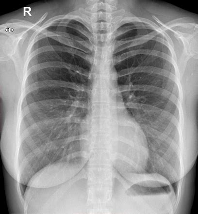 Normal chest imaging examples | Radiology Reference Article | Radiopaedia.org