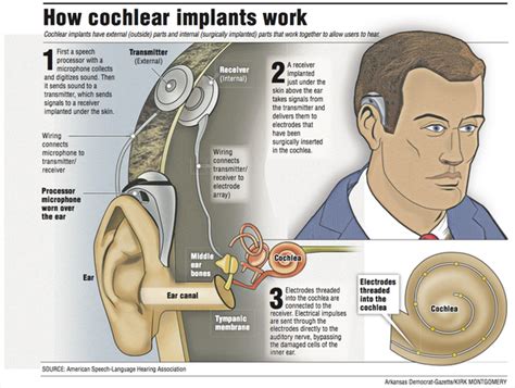 Cochlear implants give the gift of hearing, but they’re not for everyone | The Arkansas Democrat ...