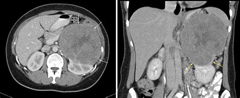 Renal Cell Carcinoma Radiology At St Vincent S University Hospital | My XXX Hot Girl