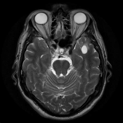 Anterior temporal pole perivascular space | Image | Radiopaedia.org