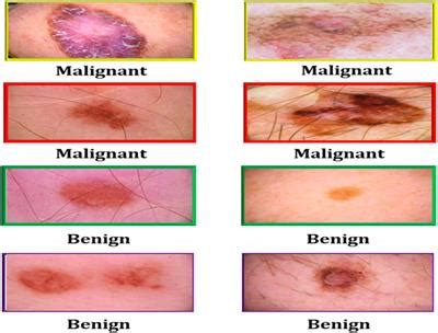 Frontiers | Early and accurate detection of melanoma skin cancer using ...