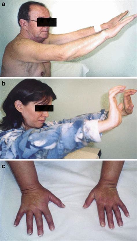 Bethlem myopathy, causes, symptoms, diagnosis, treatment & prognosis