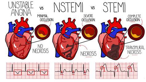 Acute Coronary Syndrome (Heart Attack) - Unstable Angina vs NSTEMI vs ...