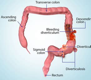 Diverticular Disease Dallas, TX | Colostomy Dallas, TX