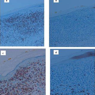 Photographs of immunohistochemistry of CD2, CD5 and CD7. 5a: More that ...