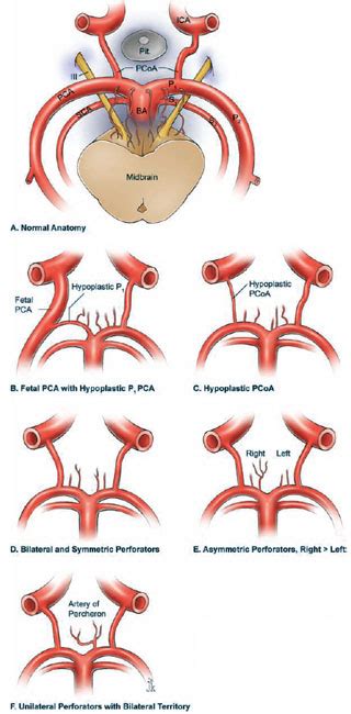 Basilar Artery Bifurcation Aneurysms | Neupsy Key