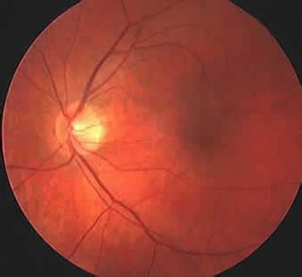 Fundus (eye) - wikidoc