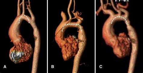 Morphological variations of the aortic arch in patients following... | Download Scientific Diagram