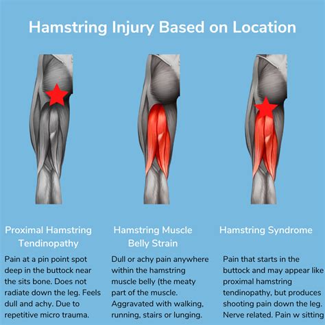 Running Injury Spotlight: Hamstrings — The Run Rx