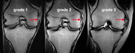 Mri Knee Mcl Tear