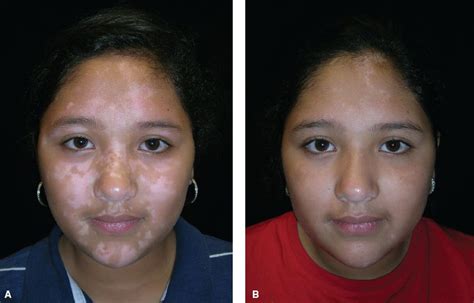 Vitiligo in Children - Best Vitiligo Treatment