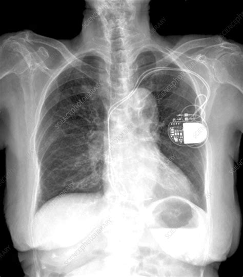 Pacemaker Types By X Ray