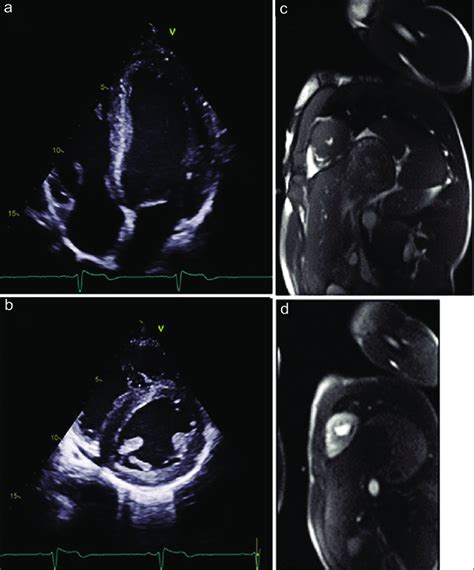 Baseline echocardiography in four-chamber view apical view and ...