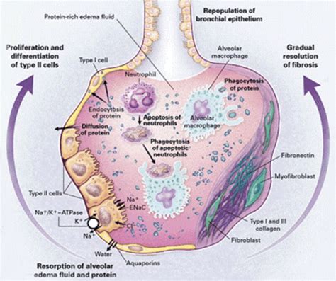 ARDS. Causes, symptoms, treatment ARDS