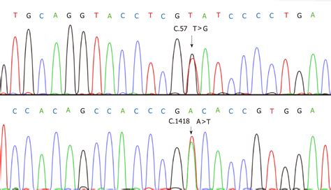 Synchronous multiple primary gastrointestinal cancers with CDH1 mutations: A case report