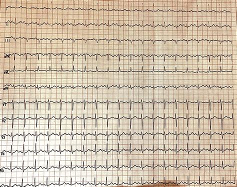 Atrial Tachycardia Masquerading As Inappropriate Sinus Tachycardia (IST ...