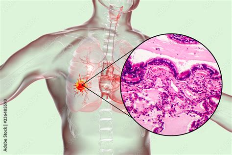 Lung cancer, 3D illustration and photo under microscope. Light ...