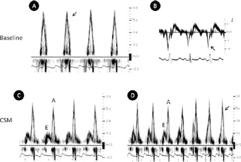 Carotid sinus massage in the echocardiography laboratory. | Semantic Scholar