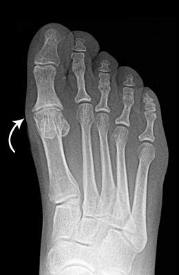 Hallux Rigidus Before and After Pictures, Big Toe Arthritis