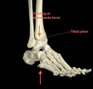 Tibial Plafond