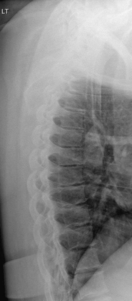 Thoracic Spine Lateral View