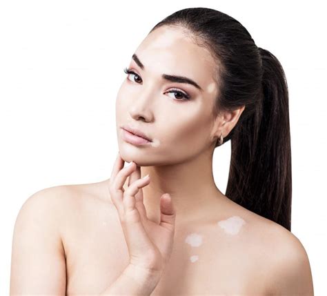 Busque estos 5 signos comunes del vitíligo: Easton Dermatology Associates: Dermatólogos ...