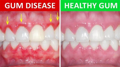 Gingivitis (Gum Disease)- Know everything about it.