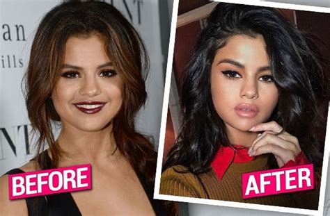 5 Celebrities Who Had Lip Augmentation