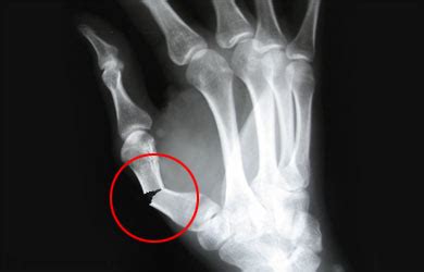 Compound Fractures | Open Fractures - Symptoms, Diagnosis,Treatment