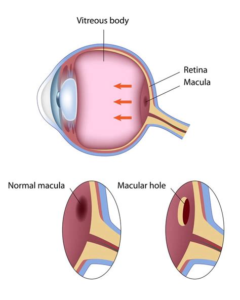 Macular Hole Eye Surgery Recovery | Eye surgery, Surgery recovery ...