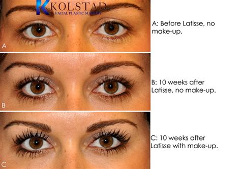 Latisse Eyelash Results | Dr. Kolstad - San Diego Facial Plastic Surgeon