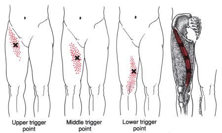 Sartorius | The Trigger Point & Referred Pain Guide