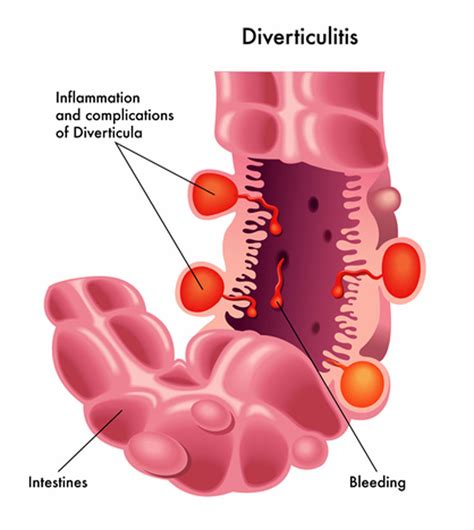 Diverticulitis and Low Back Pain: 5 Common Complications | Treatments