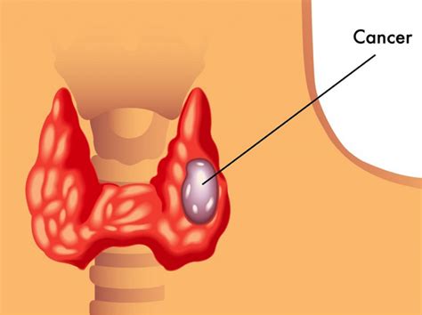 Thyroid Cancer: A Comprehensive Guide and The Top 6 Ways To Prevent It | Dr. Alan Christianson