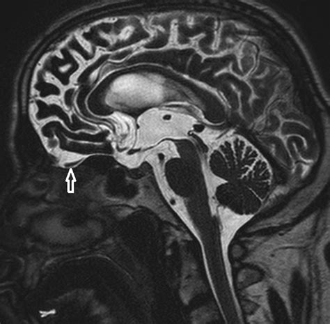 Olfactory bulb volume in patients with normal-pressure hydrocephalus: an MRI evaluation ...