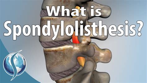 Spondylolisthesis Images